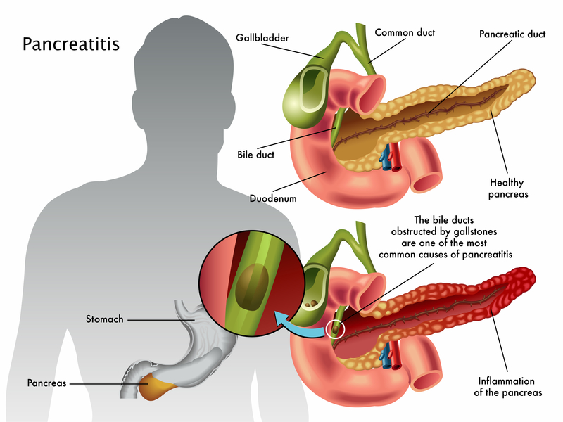 Pancreatitis Overview Harvard Health